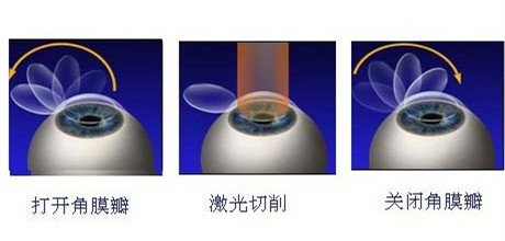 英國(guó)政府禁止眼睛激光手術(shù) 易視界