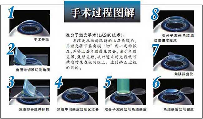 英國(guó)政府禁止眼睛激光手術(shù) 易視界