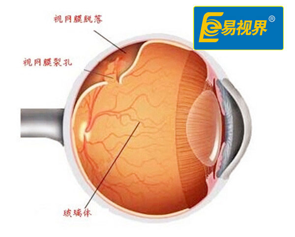 視網(wǎng)膜脫離與哪些因素有關(guān)