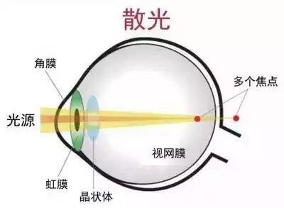 易視界護(hù)眼專家為您講解什么是散光