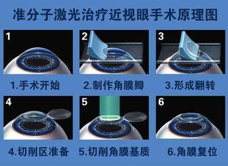 激光手術(shù)過(guò)程