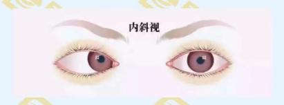 什么是調(diào)節(jié)性內(nèi)斜視？