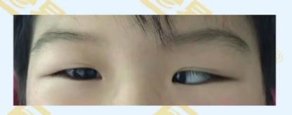 什么是先天性內(nèi)斜視？