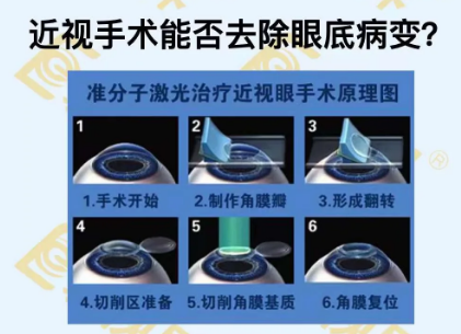 近視手術(shù)能否去除眼底病變？