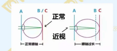 哪個(gè)年齡近視度數(shù)最容易增長？