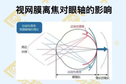 視網(wǎng)膜離焦對眼軸的影響