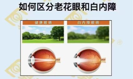 如何區(qū)分老花眼和白內(nèi)障？
