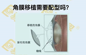 角膜移植需要配型嗎？